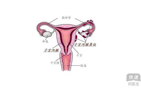 子宫腺肌症的最新疗法